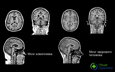 Фотографии мозга